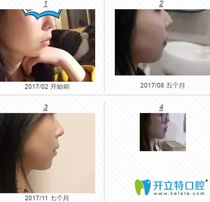 去福州格萊美口腔做1-11個月右臉變化圖片