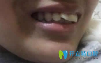 我在濰坊可恩口腔做隱形牙齒矯正1年后成功和齙牙說拜拜
