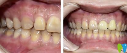 在重慶眾植博仕口腔做完超薄牙貼面后可以放心露齒笑了