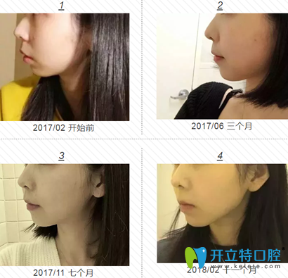 我在福州格萊美做牙齒矯正1-11個月左臉變化過程圖