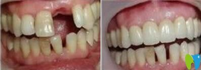 重慶眾植博仕口腔張延昭種植牙效果對比圖