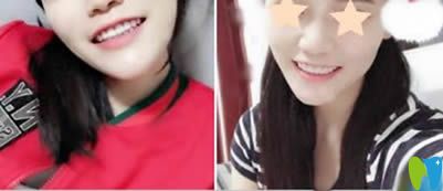 重慶眾植博仕口腔牙貼面美白后照片 重慶眾植博仕口腔牙貼面美白后照片