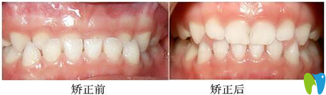 泉州泉興口腔價(jià)格表:種植牙價(jià)格1780元/根管治療價(jià)格1599元起