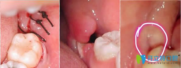 拔智齒牙洞窟窿恢復(fù)過程圖