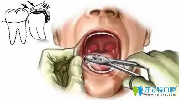 拔智齒后有個洞怎么辦？請看拔智齒牙洞窟窿恢復過程圖