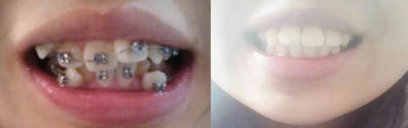 分享高中畢業(yè)后在泉興口腔做牙齒矯正經(jīng)歷，共花費(fèi)12000元