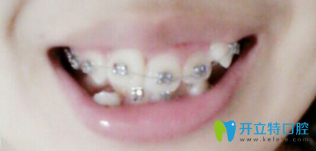 惠雯婷院長正畸個月