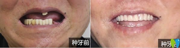 半口牙缺失種植案例及對(duì)比照