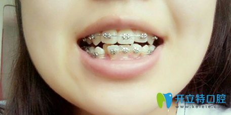 我在泉興口腔做牙齒矯正第四個月