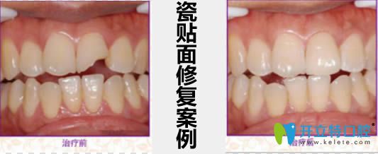 瓷貼面修復(fù)案例及前后對(duì)比效果