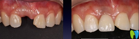 石磊單顆牙種植真人案例