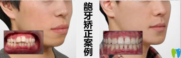 貴陽華美口腔齙牙矯正臉型變化圖 貴陽華美口腔齙牙矯正臉型變化圖
