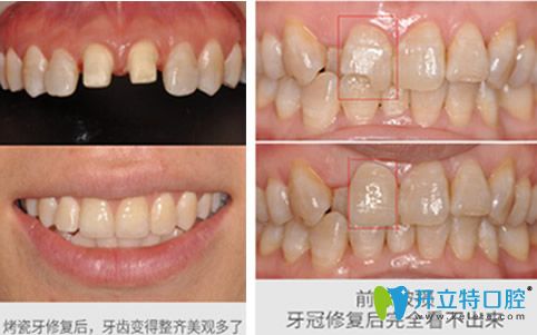 深圳河山齒科趙思詩怎么樣？來看牙齒修復(fù)案例前后效果對比圖
