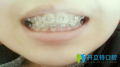 惠院長矯正后第13個月變化圖