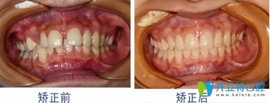 成人牙齒稀疏矯正前后對(duì)比效果
