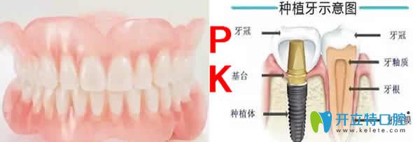 活動假牙和種植牙對比圖