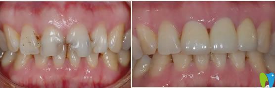齲齒修復(fù)案例及對(duì)比效果