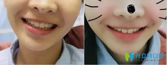 在貴陽華美口腔做完牙齒矯正23個月后的照片