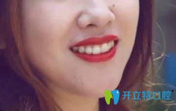 可恩口腔戴隱適美隱形矯正器第559天效果圖照片