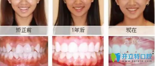 成人虎牙矯正案例及一后后變化圖