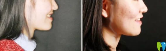 成人地包天矯正后臉型變化圖