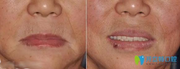 <!--<i data=20240703-sp></i>-->圣貝口腔彭儀珺醫(yī)生全口活動假牙修復案例