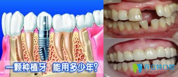 種植牙能有多少年