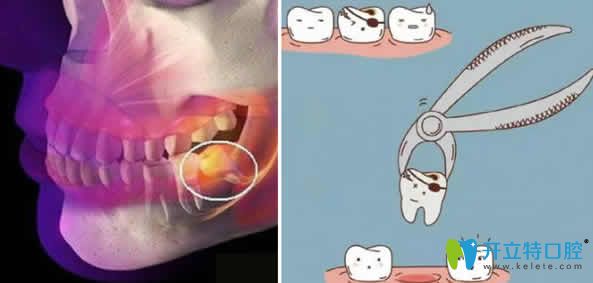 科普：拔智齒后吃什么食物能恢復(fù)的快