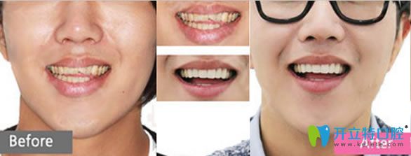 雷桂芳醫(yī)生前門牙修復(fù)前后對(duì)比案例