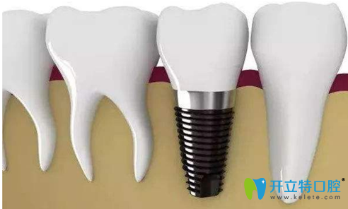 種牙用什么材料好？我是該選2千的，還是2萬的？