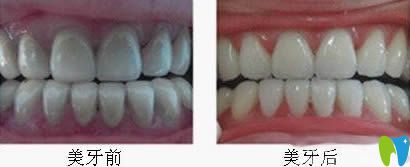 威海舒好口腔郝悅言牙齒冷光美白效果對比圖