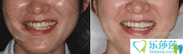 <!--<i data=20240703-sp></i>-->岳秀清醫(yī)生口腔修復案例對比圖