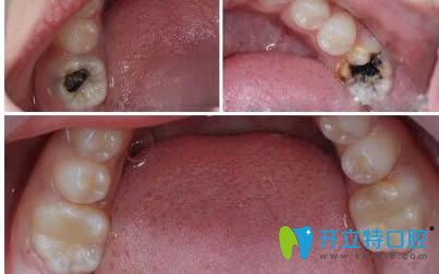 威海舒好口腔李慧齲齒修復(fù)效果對比圖 威海舒好口腔李慧齲齒修復(fù)效果對比圖