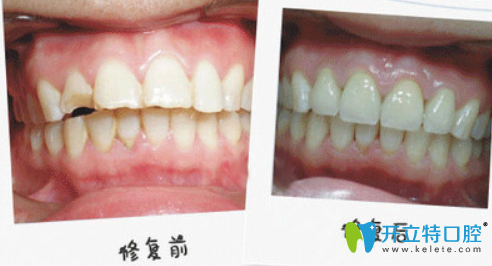 重慶齊美口腔王婷怎么樣？王婷牙齒修復(fù)真人案例效果來(lái)驗(yàn)證