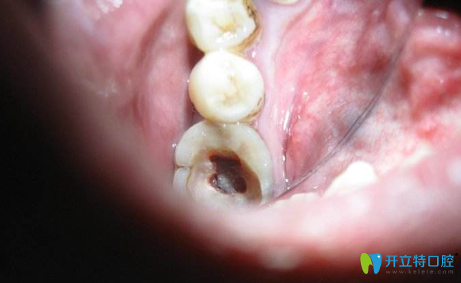 后悔給孩子做根管治療，體驗(yàn)后揭露醫(yī)生不會說的根管秘密