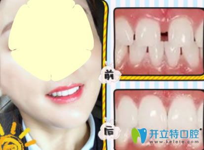 新橋口腔3D瓷貼面修復牙齒案例前后效果對