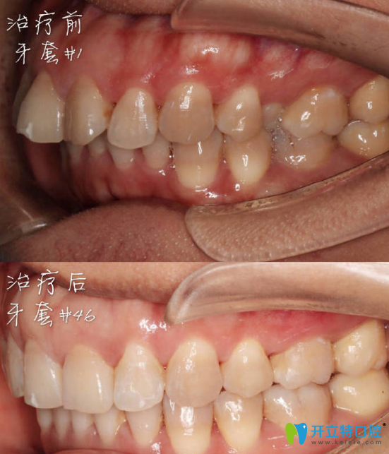 <!--<i data=20240703-sp></i>-->口腔正畸好不好？來看新橋口腔拔牙做隱形牙齒矯正案例