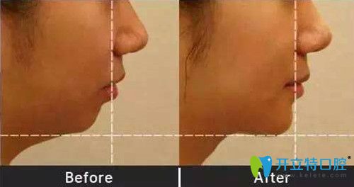 重慶齊美口腔矯正靠譜嗎？來(lái)看周映丞齙牙矯正真人案例前后效果對(duì)比圖