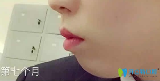 我在成都德頓齒科做牙齒矯正第7個(gè)月照片