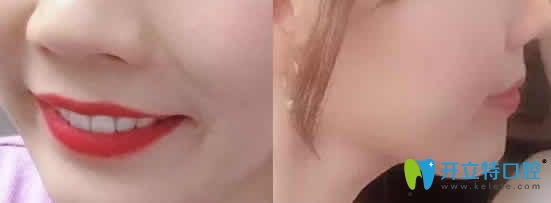 我在成都德頓齒科做牙齒矯正2年效果