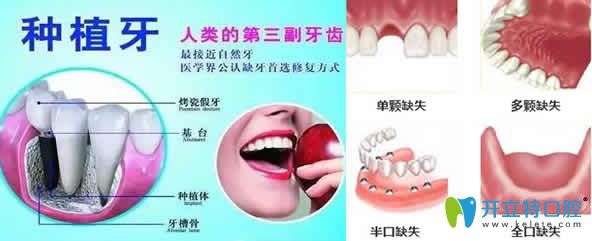 種植牙的誤區(qū)