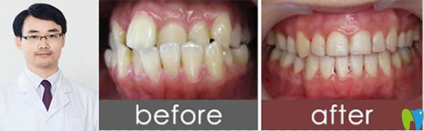 臺州維多利亞青少年地包天矯正前后對比照