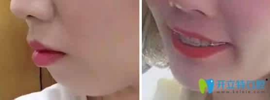 我在成都德頓齒科做陶瓷托槽矯正第15個(gè)月照片