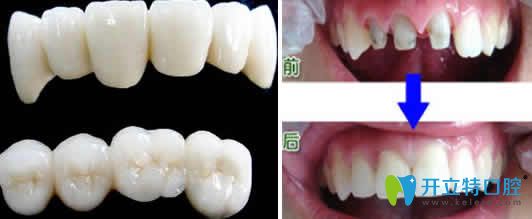 武漢優(yōu)益佳口腔梅紅娟全瓷牙修復案例圖