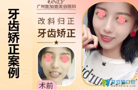 廣州壹加壹口腔蘇文新牙齒矯正案例圖