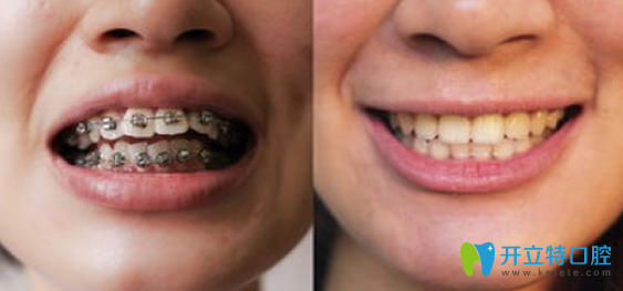 牙齒矯正前后對(duì)比圖