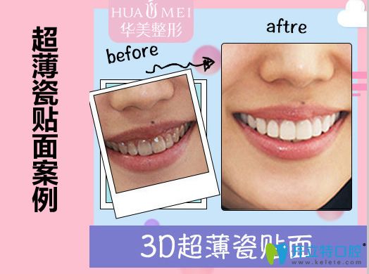 汕頭華美口腔<!--<i data=20240703-sp></i>-->超薄瓷貼面修復(fù)前后對比效果