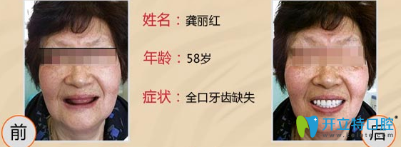 深圳格倫菲爾口腔林帆種植牙怎么樣？案例來(lái)啦