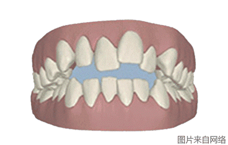 戴隱形雙模牙套牙齒動(dòng)圖