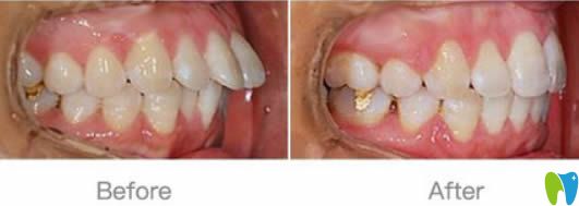 長(zhǎng)春超龍牙博士王聰醫(yī)生成人齙牙矯正案例